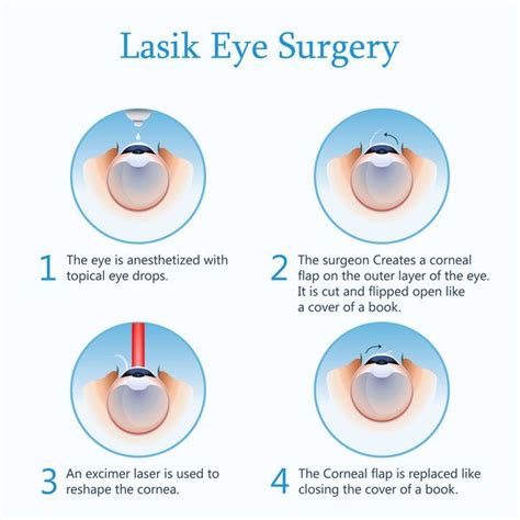 What Is Lasik And Refractive Surgery