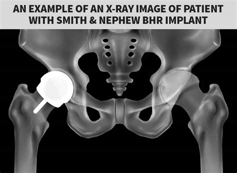 Smith And Nephew Hip Recall Lawsuit What You Must Know