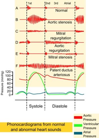 Heart murmurs may be caused by a number of factors or diseases, including defective heart a heart murmur is an extra noise heard during a heartbeat. Heart Murmurs