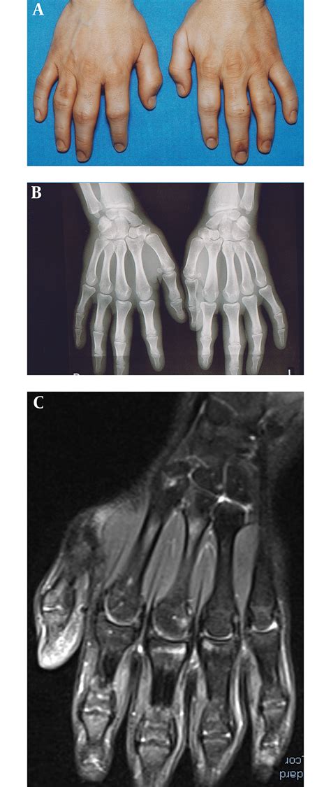 Enlargement Of The Proximal Interphalangeal Joints Ii Iv Of Both The