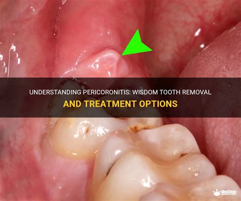 Understanding Pericoronitis Wisdom Tooth Removal And Treatment Options