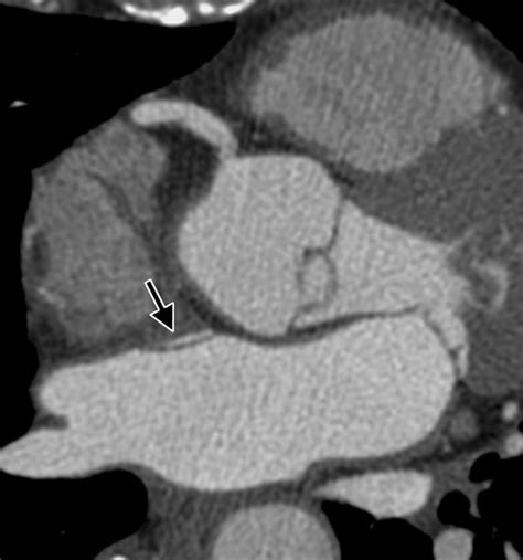 Patent Foramen Ovale Diagnosis With Multidetector Ct