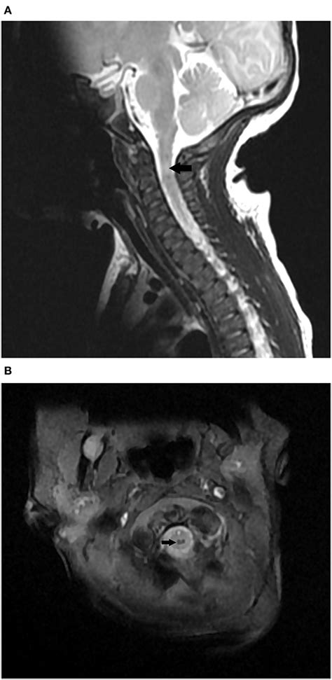 Frontiers Unusual Presentations Of Birth Related Cervical Spinal Cord