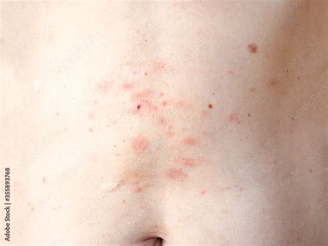 Foto Stock Skin Rash Treatment On Woman Body Shingles Disease Herpes