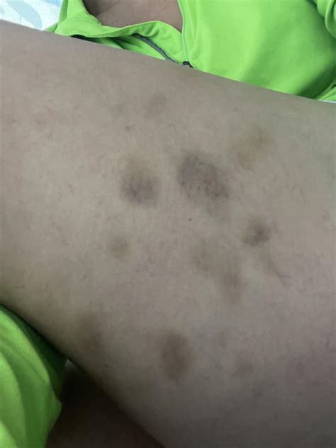 Unexplained Bruising On Back Of Legs Raskdoctorsmeeee