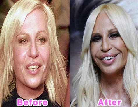 Fresh Pic Worst Celebrity Plastic Surgery Disasters