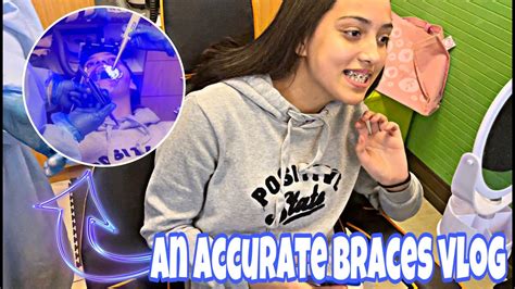 Getting Braces At 15 Youtube