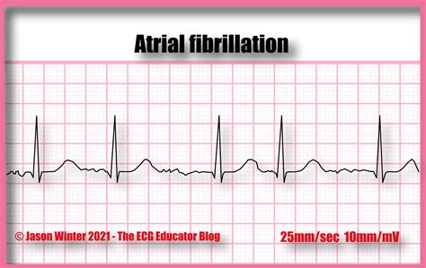 Can You Die From Atrial Fibrillation Atrial Fibrillation