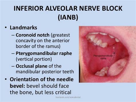 Inferior Alveolar Nerve Block Dental Medical Dental Dental Health