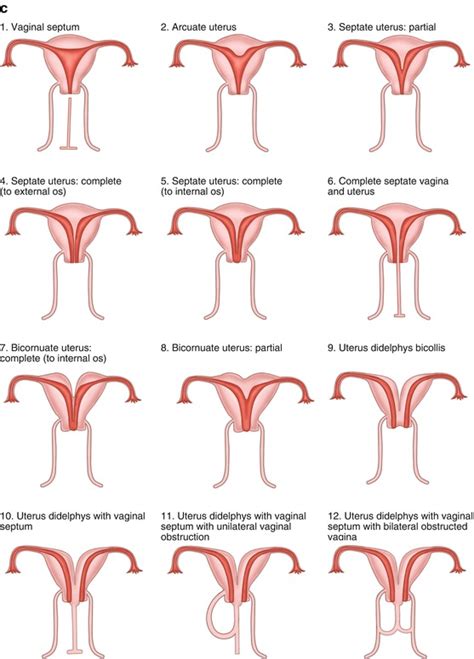Abnormal Development Of The Female Genital Tract Obgyn Key