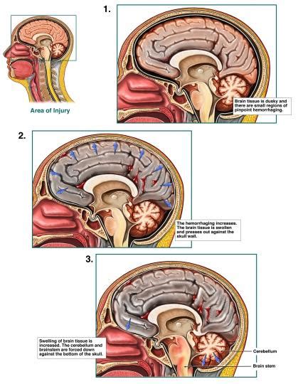 Anoxic Brain Damage Information The Mount Sinai Hospital