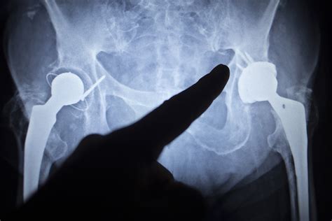 Professor Ian Harris Osteoporosis Hip Fracture Warning Signs Missed