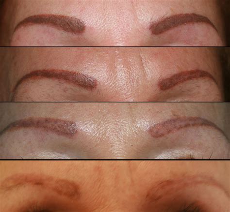 The top 10 most removed tattoos. Tattoo Removal - Exhale Body Rejuvenation