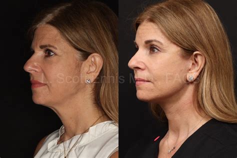 Buccal Fat Removal Before And After Photos Ennis Md