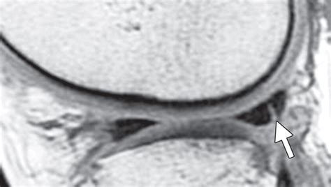 MR Imagingbased Diagnosis And Classification Of Meniscal Tears RadioGraphics