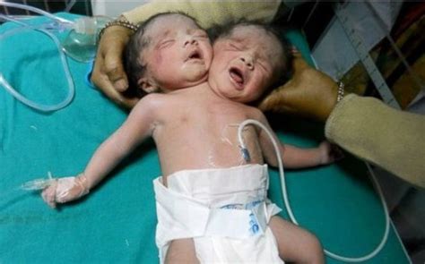 Un Bébé à Deux Têtes Est Né En Inde
