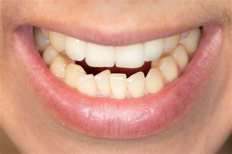 Crooked Teeth Causes Symptoms And Treatment