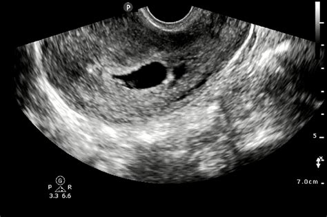 Subchorionic Hemorrhage Anechoic Collection Adjacent To Gestational
