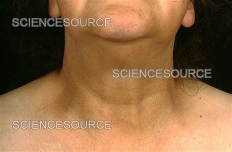 Photograph Hypothyroidism Swollen Neck Science Source Images