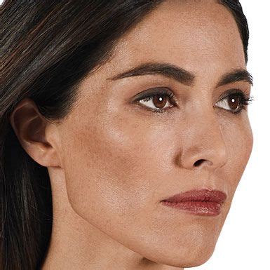 Cheek fillers offer several benefits to those who undergo the treatment. Filler for Wrinkles | JUVÉDERM® in 2020 | Cheek fillers ...