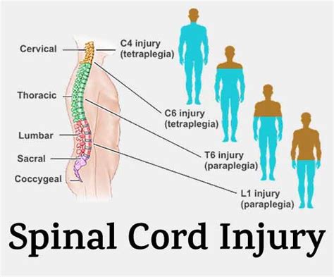 Spinal Cord Injury Si Free Trial Pass The Ot