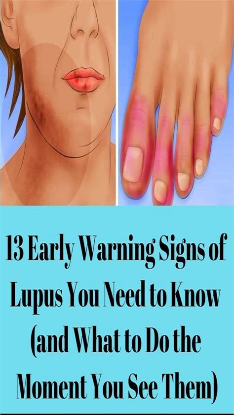 13 EARLY WARNING SIGNS OF LUPUS YOU NEED TO KNOW AND WHAT TO DO THE