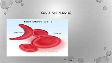 Ppt Sickle Cell Macrocytic And Microcytic Anemia Powerpoint
