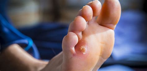 Ottawa Foot Clinic Long Lasting Solutions For Your Foot And Toenails