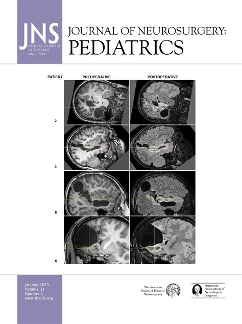 Predictive Models For Postoperative Hydrocephalus In Pediatric Patients