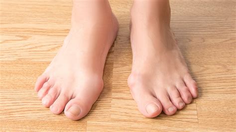 Rheumatoid Arthritis And Your Feet