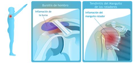 Dr Carlos Godoy Síndrome de Pinzamiento Subacromial