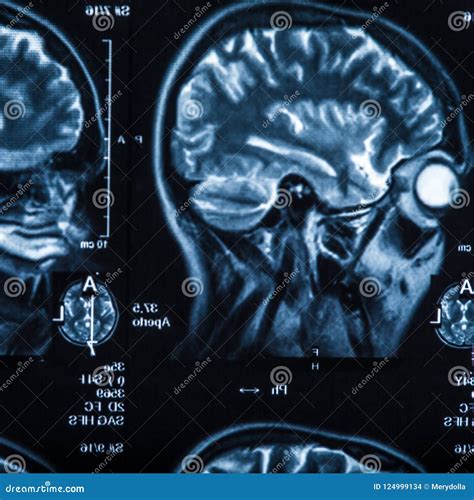 La Radiograf A Del Cerebro Humano Foto De Archivo Imagen De