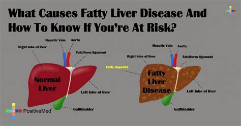 What Causes Fatty Liver Disease And How To Know If Youre At Risk