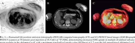 Figure 1 From Positron Emission Tomographycomputed Tomography Petct