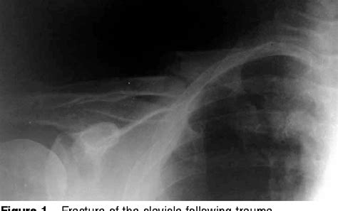 Figure 1 From Subclavian Vein Thrombosis Following Fracture Of The