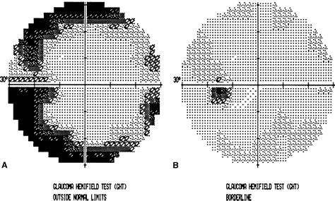 Visual Field Defects Diagram