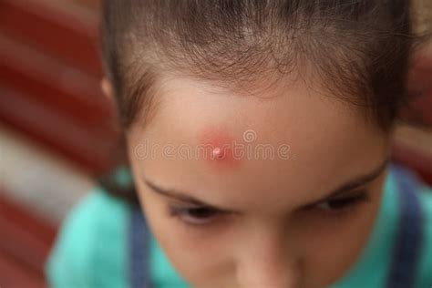 Girl With Insect Bite On Forehead Outdoors Closeup Stock Image Image
