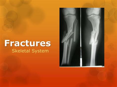 Ppt Fractures Powerpoint Presentation Free Download Id2807558