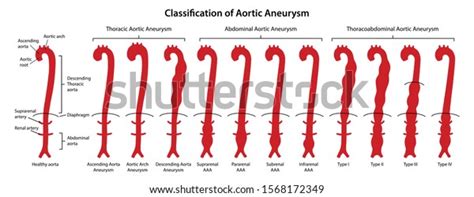Classification Aortic Aneurysms Thoracic Abdominal Thoracoabdominal