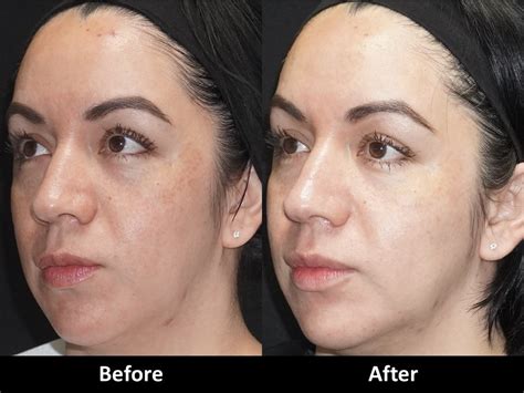 Forever Young Bbl Ipl Photofacial Before And After Med Spa In Encino