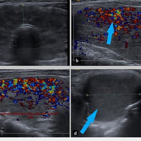 Ultrasonography Of The Thyroid Gland Showing An Enlarged Thyroid With
