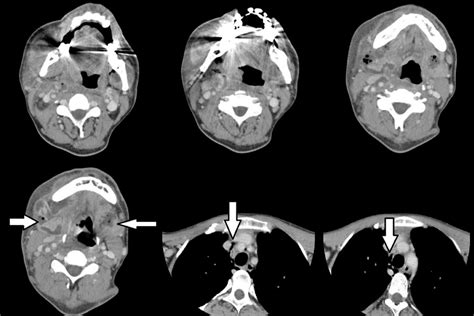 Serial Computerized Tomography Scans Of The Neck And Thoracic Region