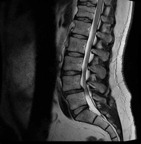 Spinal Cord Tumor Lumbar Center