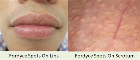 How To Get Rid Of Fordyce Spots Clear Off Fordyce Spots Lips