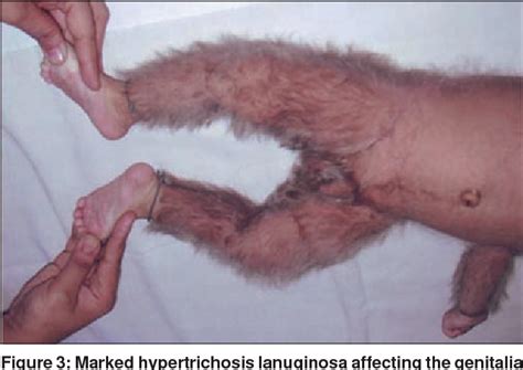 Lanugo is fine unpigmented hair that begins to grow on the baby from the fourth or fifth month of premature babies tend to have more lanugo when they're born. Figure 3 from Congenital hypertrichosis lanuginosa ...