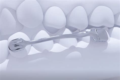 Carriere® Motion 3d™ Appliances Henry Schein® Orthodontics™