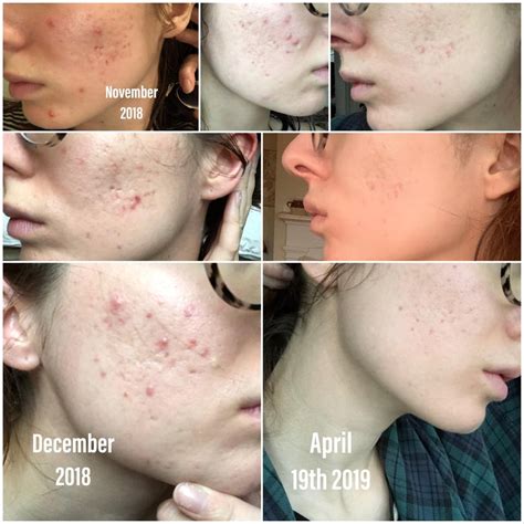 My Journey Thus Far With Active Acne And Hyperpigmentationdeep Scars