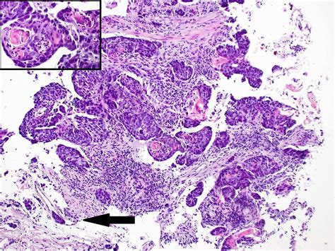 Infiltration Of Moderately Differentiated Squamous Cell Carcinoma Scc