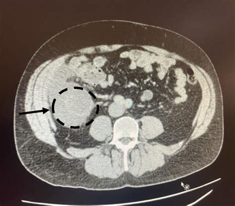 Ct Abdomen And Pelvis With Contrast Axial View Showing A Ring Enhanced