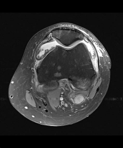 Tenosynovial Giant Cell Tumor Image Radiopaedia Org